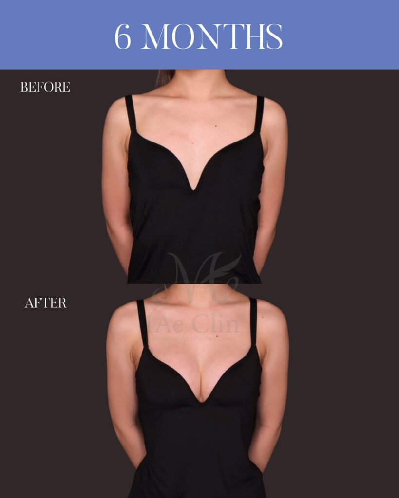 シリコンバッグ豊胸 Motiva Ergonomix2 250cc 乳腺下留置 乳房下溝切開 木下恵里沙医師症例