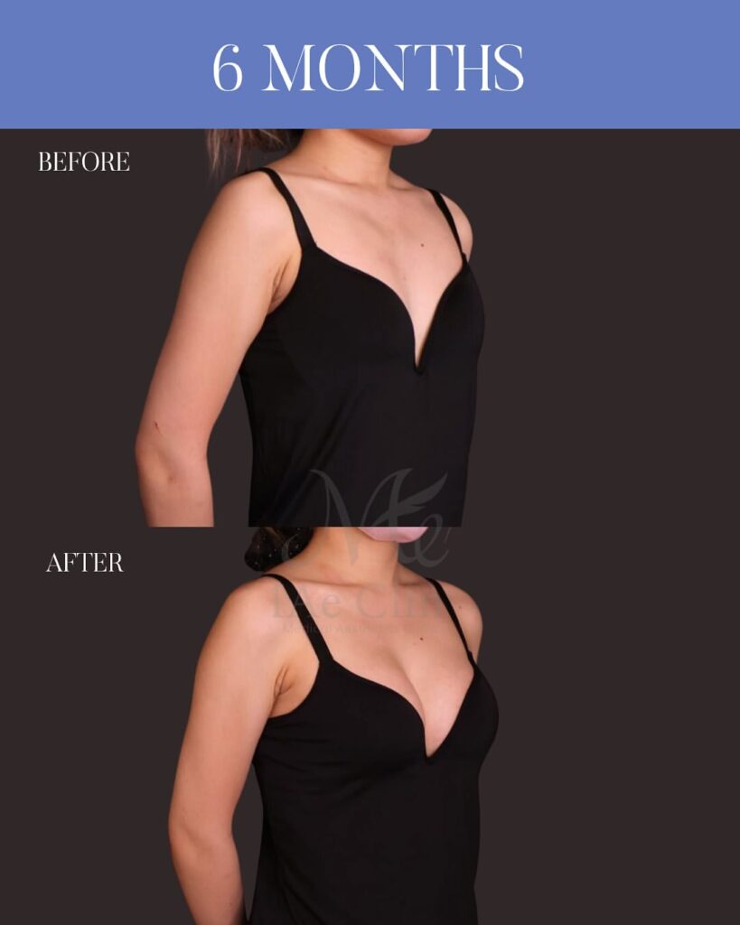 シリコンバッグ豊胸 Motiva Ergonomix2 250cc 乳腺下留置 乳房下溝切開 木下恵里沙医師症例