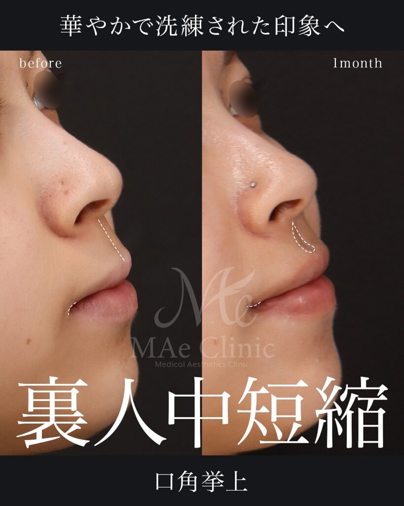 口角挙上
裏側人中短縮（傷の見えない人中短縮）
人中厚み調整3D

術後１ヵ月症例　前田翔医師