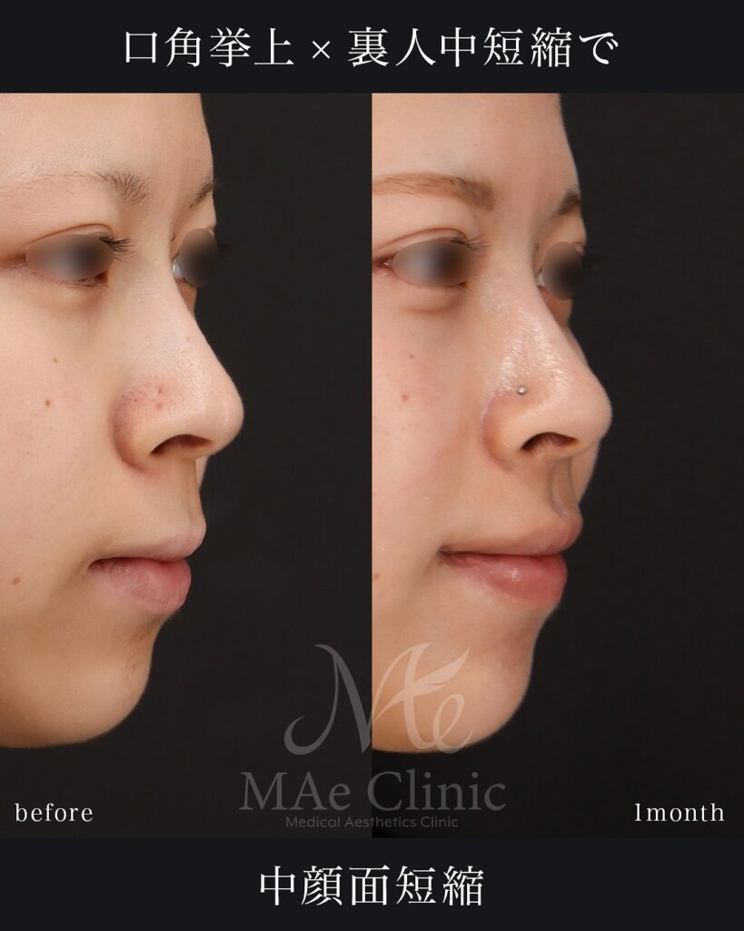 口角挙上 裏側人中短縮（傷の見えない人中短縮） 人中厚み調整3D 術後１ヵ月症例　前田翔医師