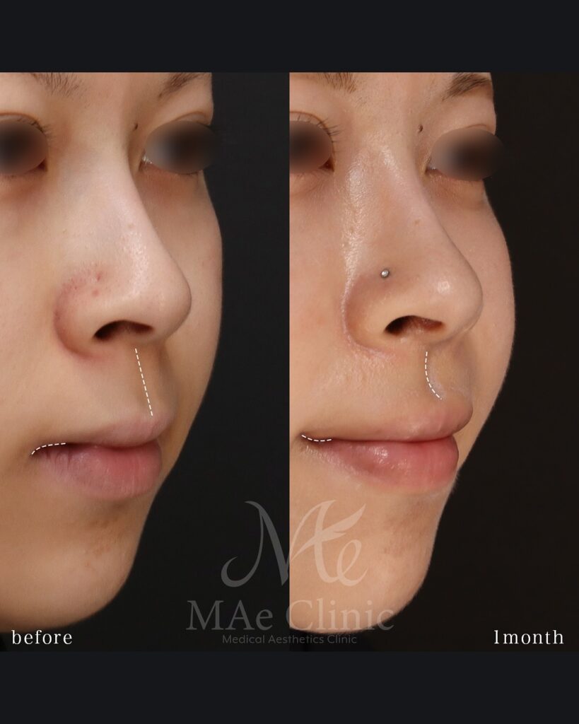 口角挙上 裏側人中短縮（傷の見えない人中短縮） 人中厚み調整3D 術後１ヵ月症例　前田翔医師