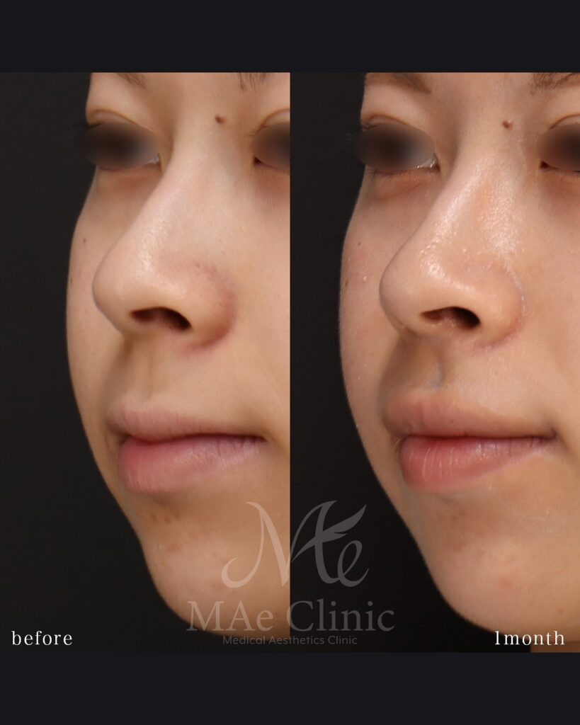 口角挙上 裏側人中短縮（傷の見えない人中短縮） 人中厚み調整3D 術後１ヵ月症例　前田翔医師