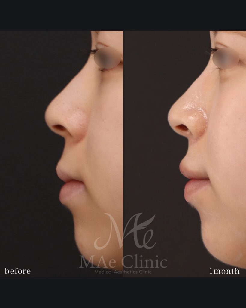 口角挙上 裏側人中短縮（傷の見えない人中短縮） 人中厚み調整3D 術後１ヵ月症例　前田翔医師