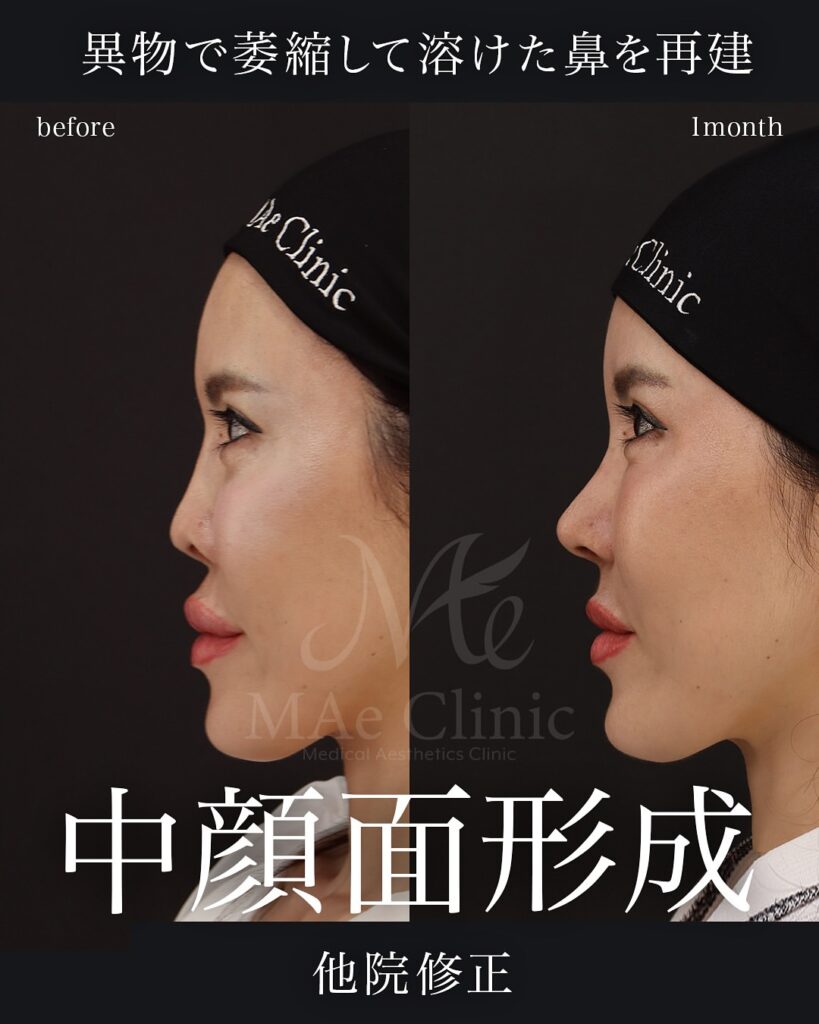 プロテーゼ抜去
鼻尖形成
鼻中隔延長(肋軟骨)
隆鼻(必要最小限の高さ補正)
眉間軟骨移植
猫貴族手術
前田翔医師症例