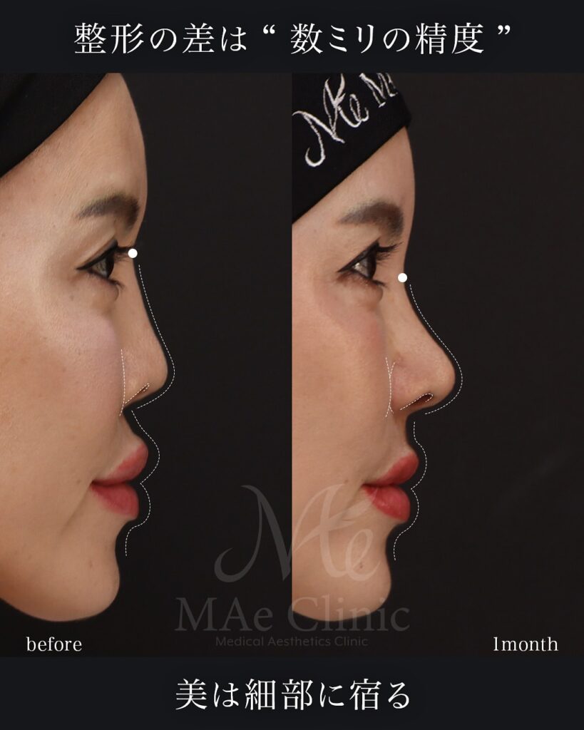 プロテーゼ抜去 鼻尖形成 鼻中隔延長(肋軟骨) 隆鼻(必要最小限の高さ補正) 眉間軟骨移植 猫貴族手術 前田翔医師症例