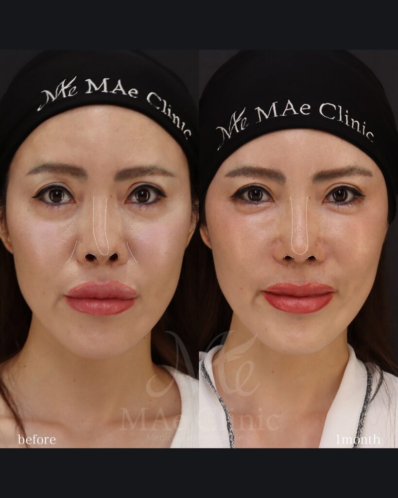 プロテーゼ抜去 鼻尖形成 鼻中隔延長(肋軟骨) 隆鼻(必要最小限の高さ補正) 眉間軟骨移植 猫貴族手術 前田翔医師症例