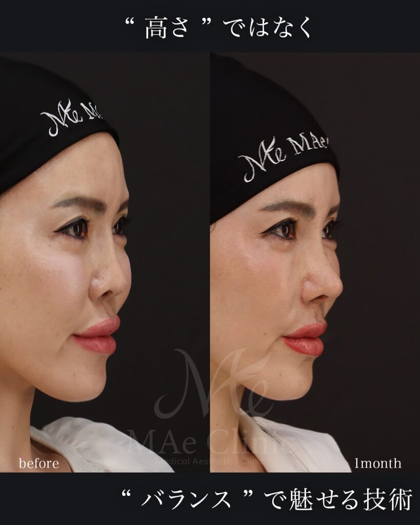 プロテーゼ抜去 鼻尖形成 鼻中隔延長(肋軟骨) 隆鼻(必要最小限の高さ補正) 眉間軟骨移植 猫貴族手術 前田翔医師症例