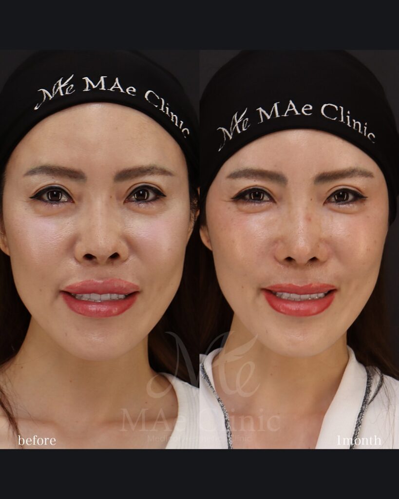 プロテーゼ抜去 鼻尖形成 鼻中隔延長(肋軟骨) 隆鼻(必要最小限の高さ補正) 眉間軟骨移植 猫貴族手術 前田翔医師症例