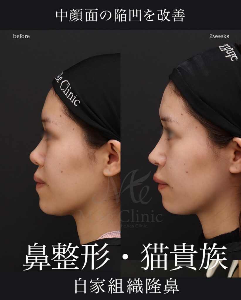 鼻中隔延長（肋軟骨） 鼻尖形成 鼻尖軟骨移植 猫手術（肋軟骨） 望月正人医師症例