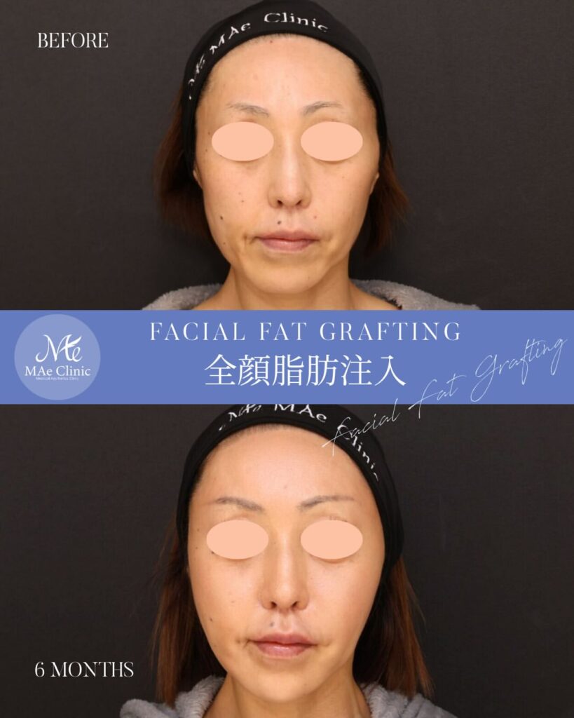全顔脂肪注入 術後６ヵ月症例写真 木下恵里沙医師