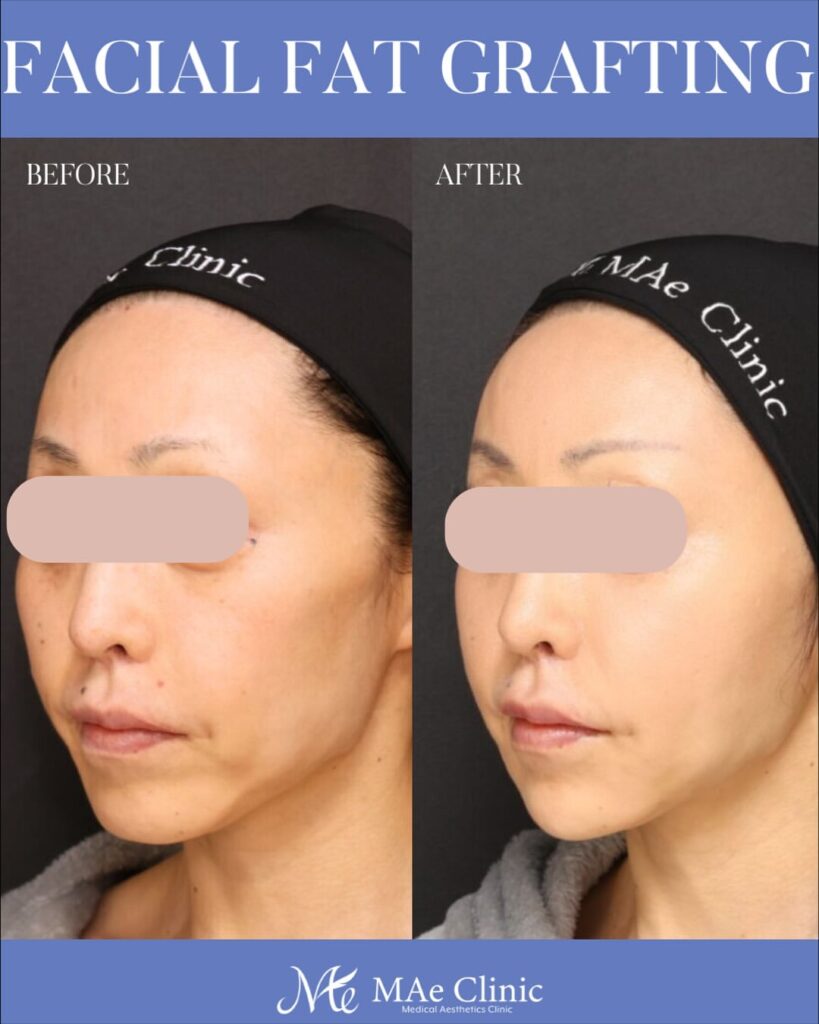 全顔脂肪注入 術後６ヵ月症例写真 木下恵里沙医師