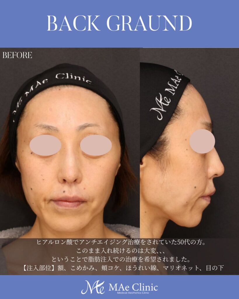 全顔脂肪注入 術後６ヵ月症例写真 木下恵里沙医師