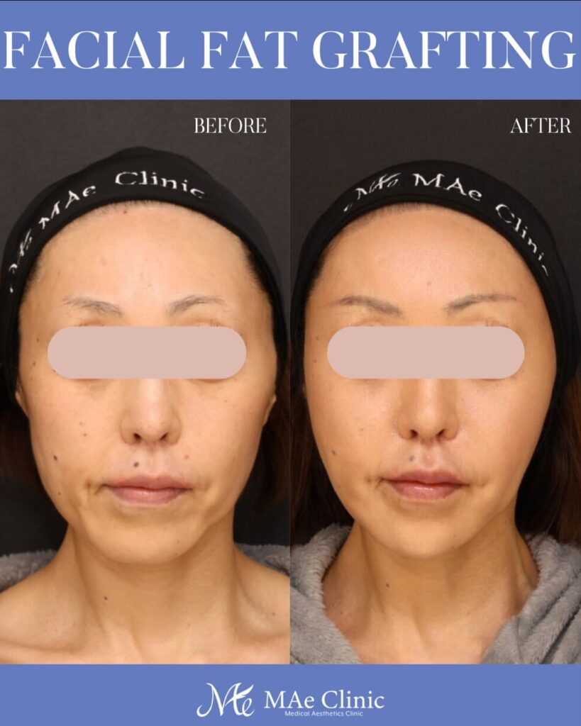 全顔脂肪注入 術後６ヵ月症例写真 木下恵里沙医師