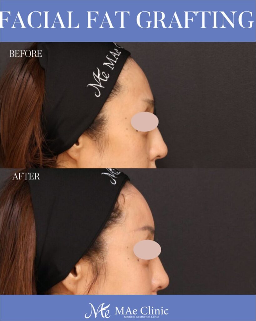 全顔脂肪注入 術後６ヵ月症例写真 木下恵里沙医師