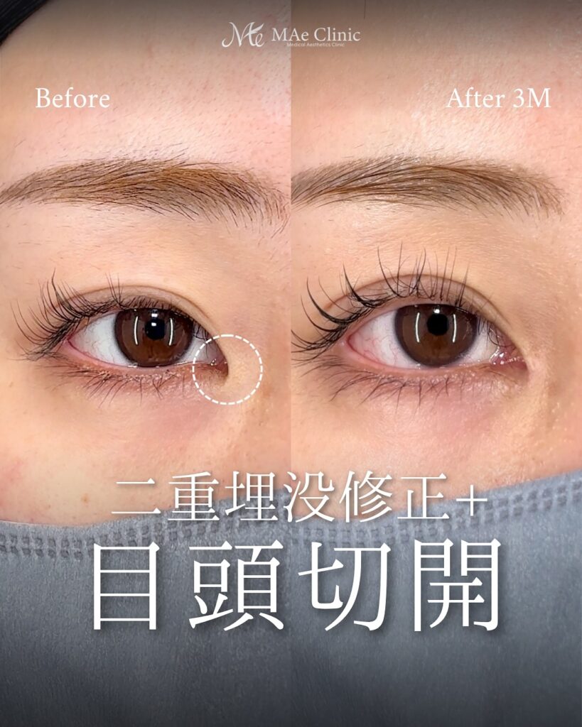 目頭切開(Z法) 二重埋没法(修正)
前之園健太医師症例