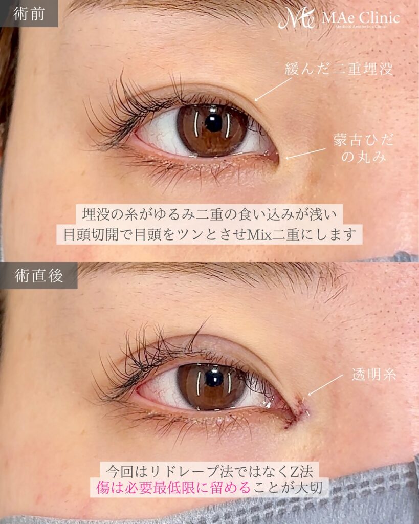 目頭切開(Z法) 二重埋没法(修正) 前之園健太医師症例