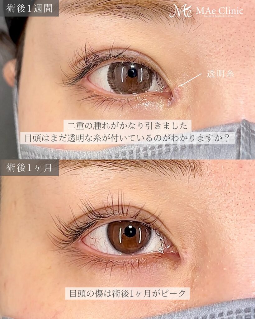 目頭切開(Z法) 二重埋没法(修正) 前之園健太医師症例
