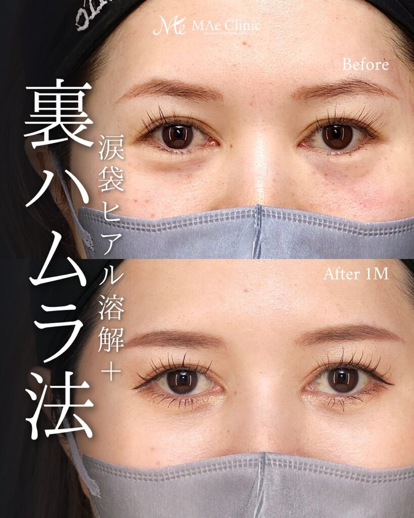 裏ハムラ法 前之園健太医師症例