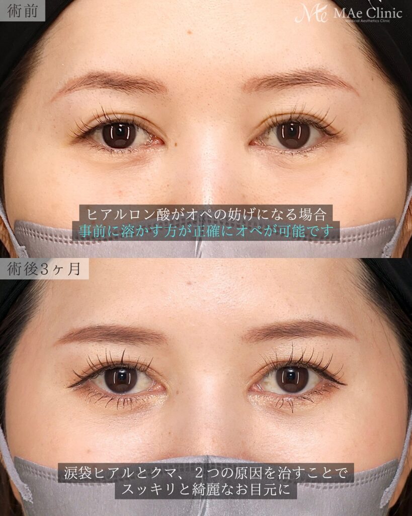 裏ハムラ法 前之園健太医師症例