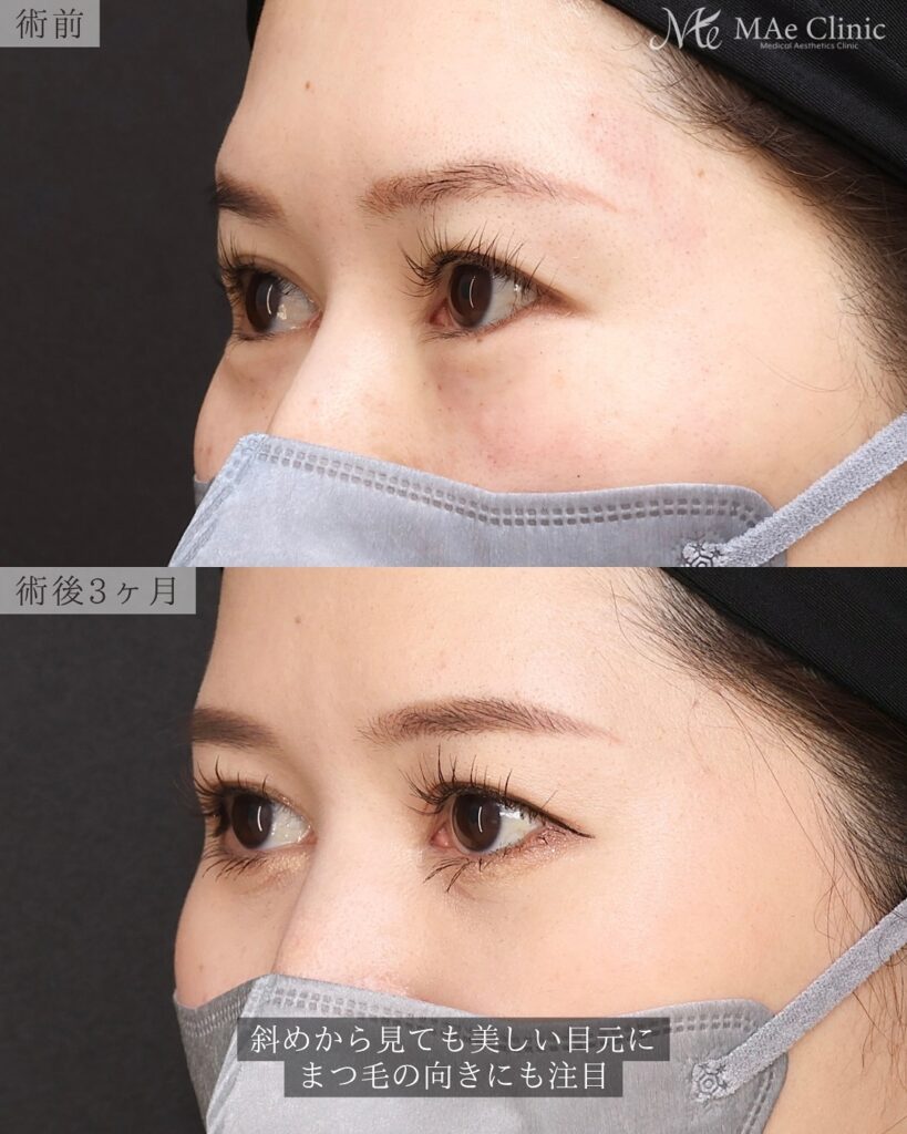 裏ハムラ法 前之園健太医師症例