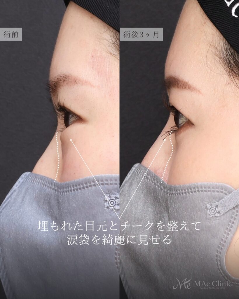 裏ハムラ法 前之園健太医師症例