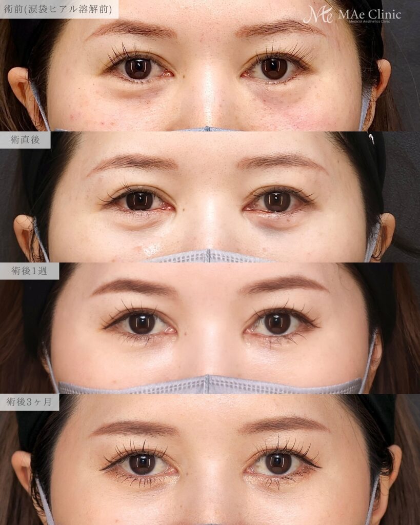 裏ハムラ法 前之園健太医師症例