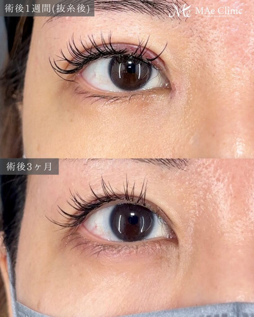 二重全切開 目頭切開 裏ハムラ法 術後３ヵ月症例 前之園健太医師