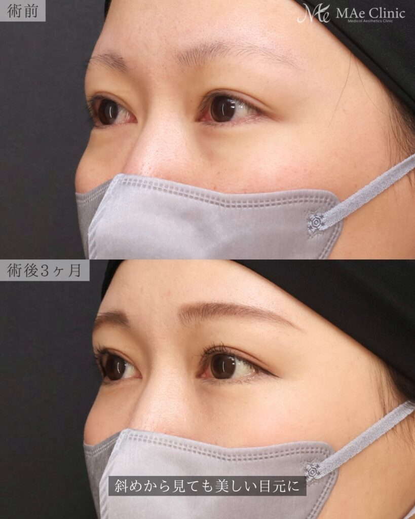 裏ハムラ 術後3ヵ月 前之園健太医師症例