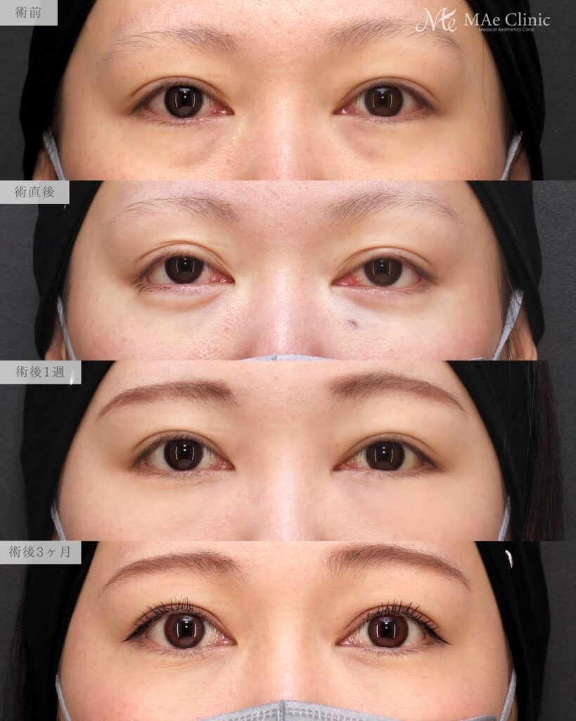 裏ハムラ 術後3ヵ月 前之園健太医師症例