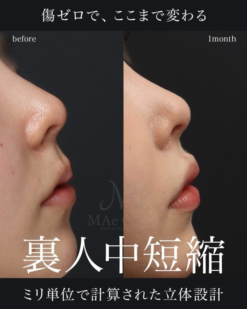 裏人中短縮　症例写真
前田翔医師症例
