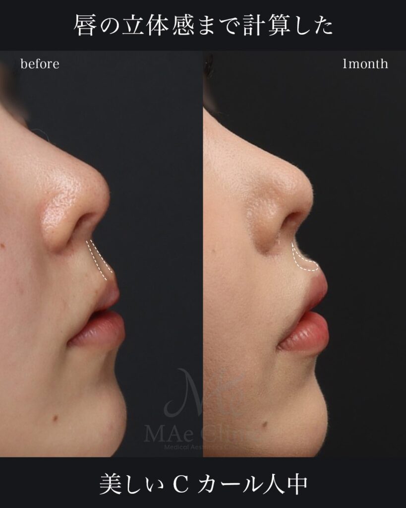 裏人中短縮　症例写真 前田翔医師症例