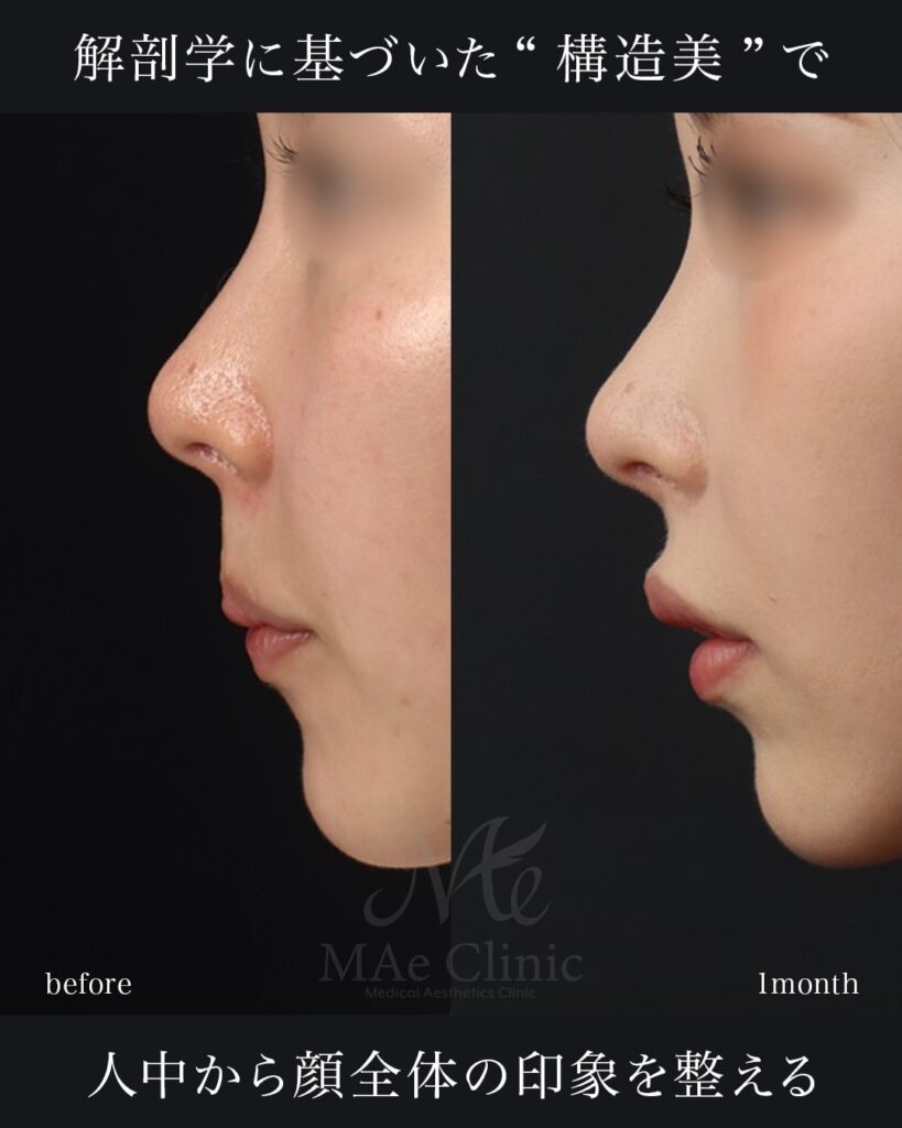 裏人中短縮　症例写真 前田翔医師症例