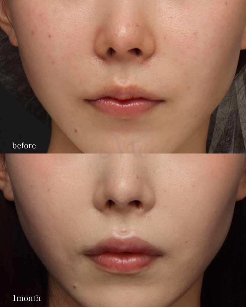 裏人中短縮　症例写真 前田翔医師症例