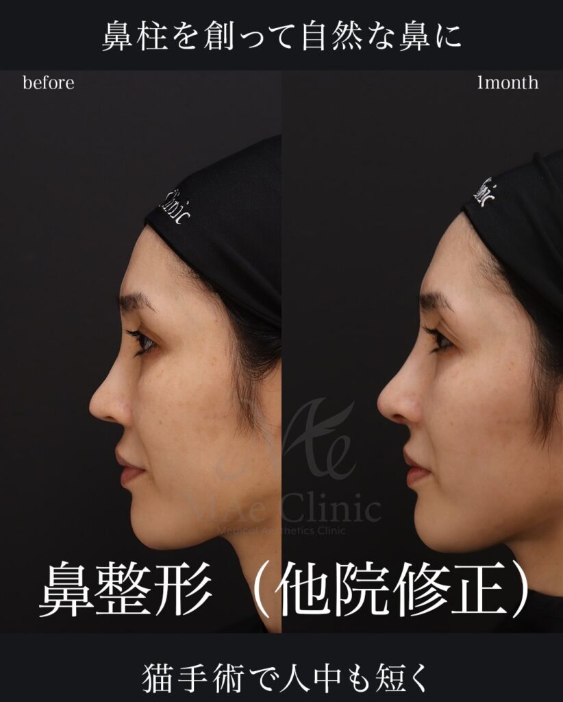 鼻中隔延長(肋軟骨による修正) 鼻尖形成 鼻尖軟骨移植 猫手術(肋軟骨)望月正人医師症例