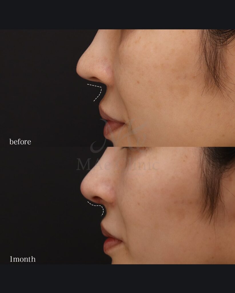 鼻中隔延長(肋軟骨による修正) 鼻尖形成 鼻尖軟骨移植 猫手術(肋軟骨)望月正人医師症例