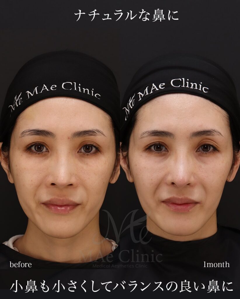 鼻中隔延長(肋軟骨による修正) 鼻尖形成 鼻尖軟骨移植 猫手術(肋軟骨)望月正人医師症例