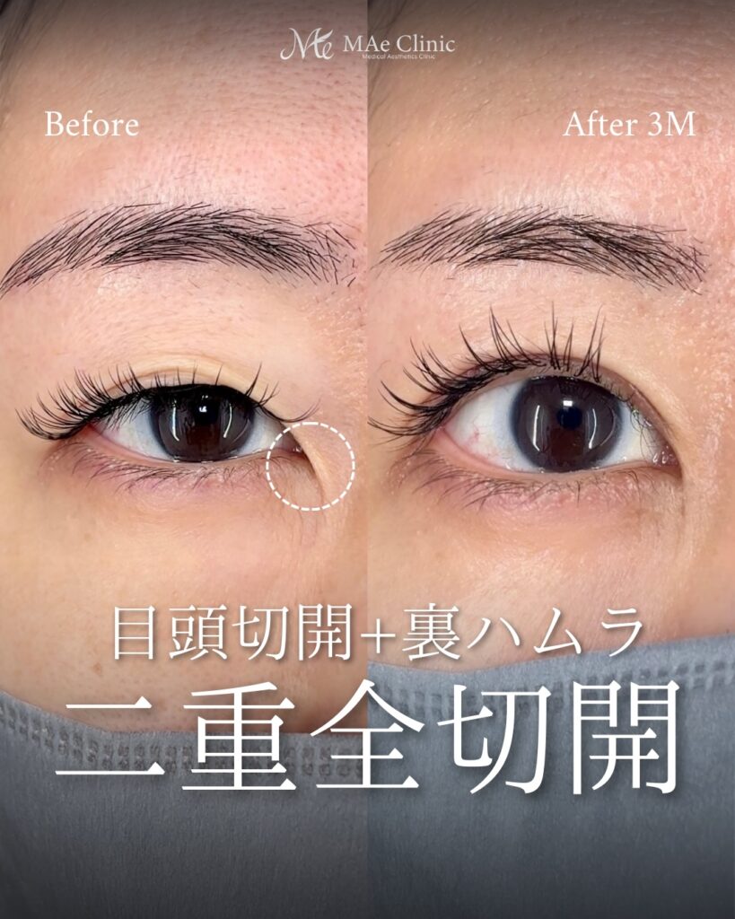 二重全切開 目頭切開 裏ハムラ法 前之園健太医師症例