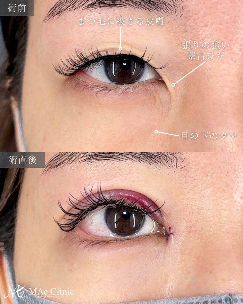 二重全切開 目頭切開 裏ハムラ法 前之園健太医師症例