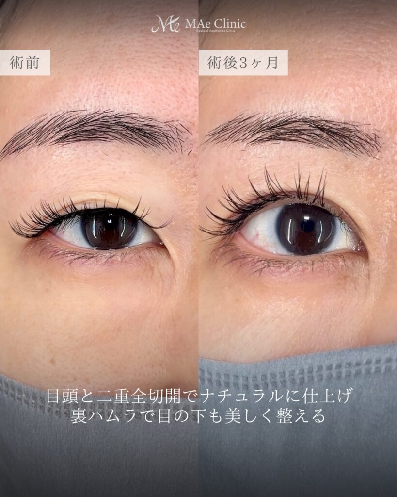 二重全切開 目頭切開 裏ハムラ法 前之園健太医師症例