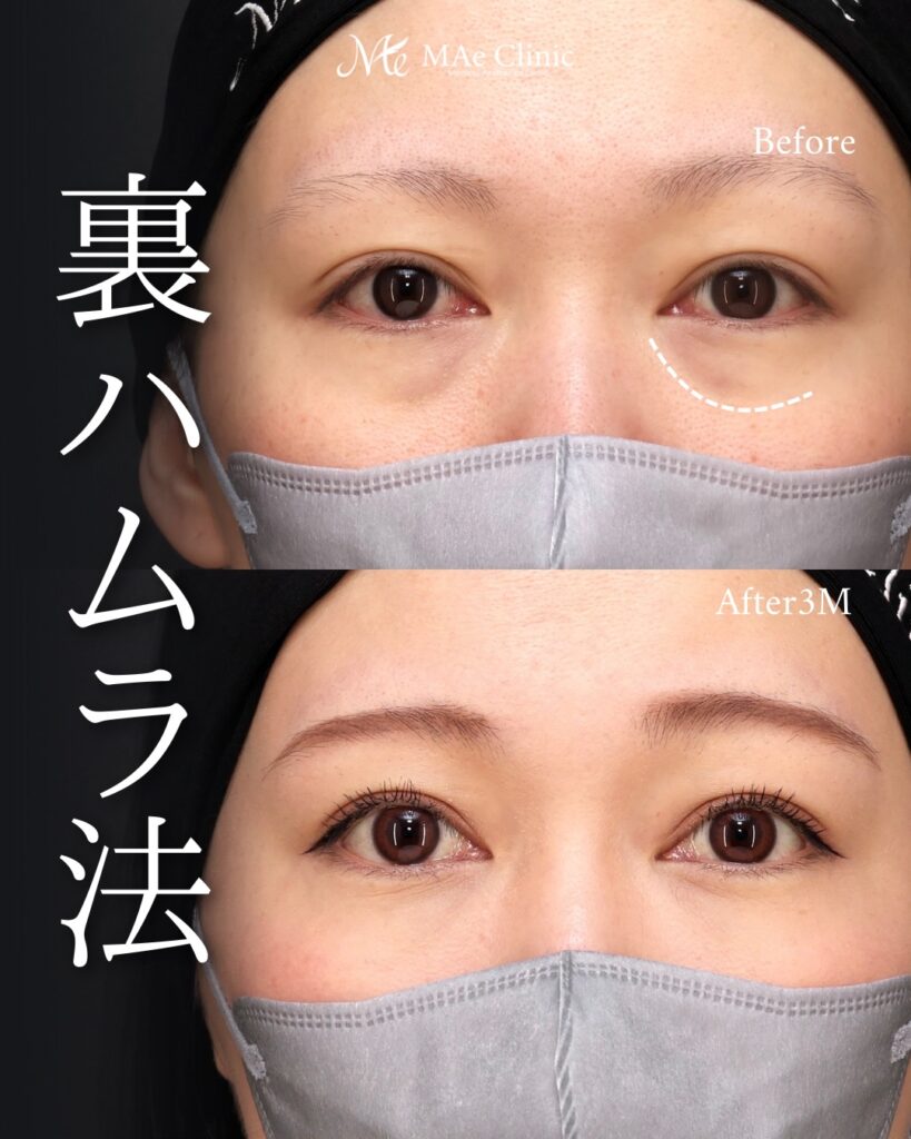 裏ハムラ 前之園健太医師症例