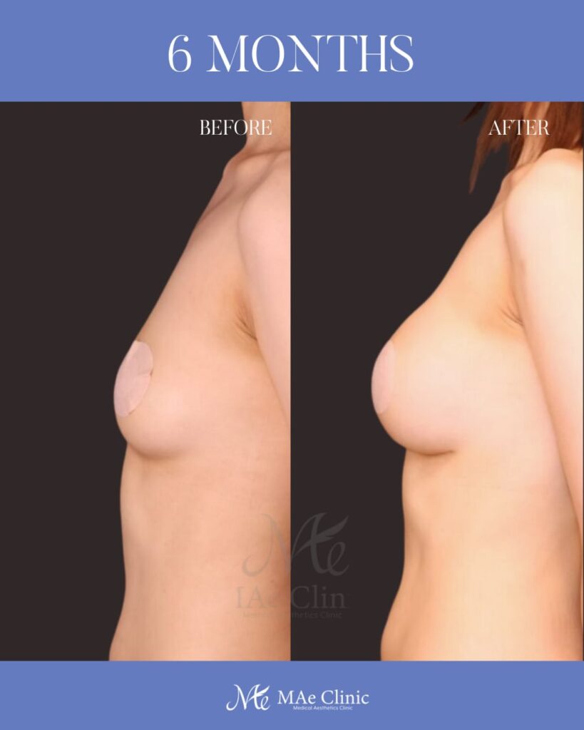 ハイブリッド豊胸 （Motiva Ergonomix2 200cc ＋ コンデンスリッチ脂肪注入 220ml） 木下恵里沙医師症例