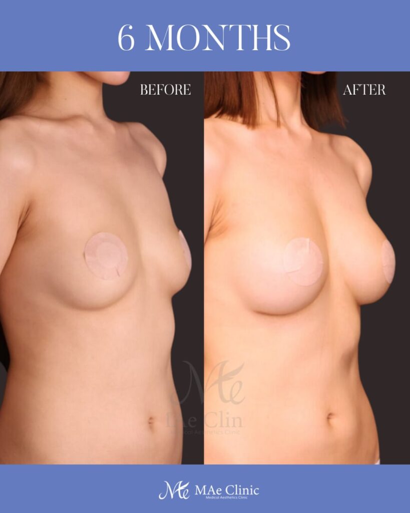 ハイブリッド豊胸 （Motiva Ergonomix2 200cc ＋ コンデンスリッチ脂肪注入 220ml） 木下恵里沙医師症例