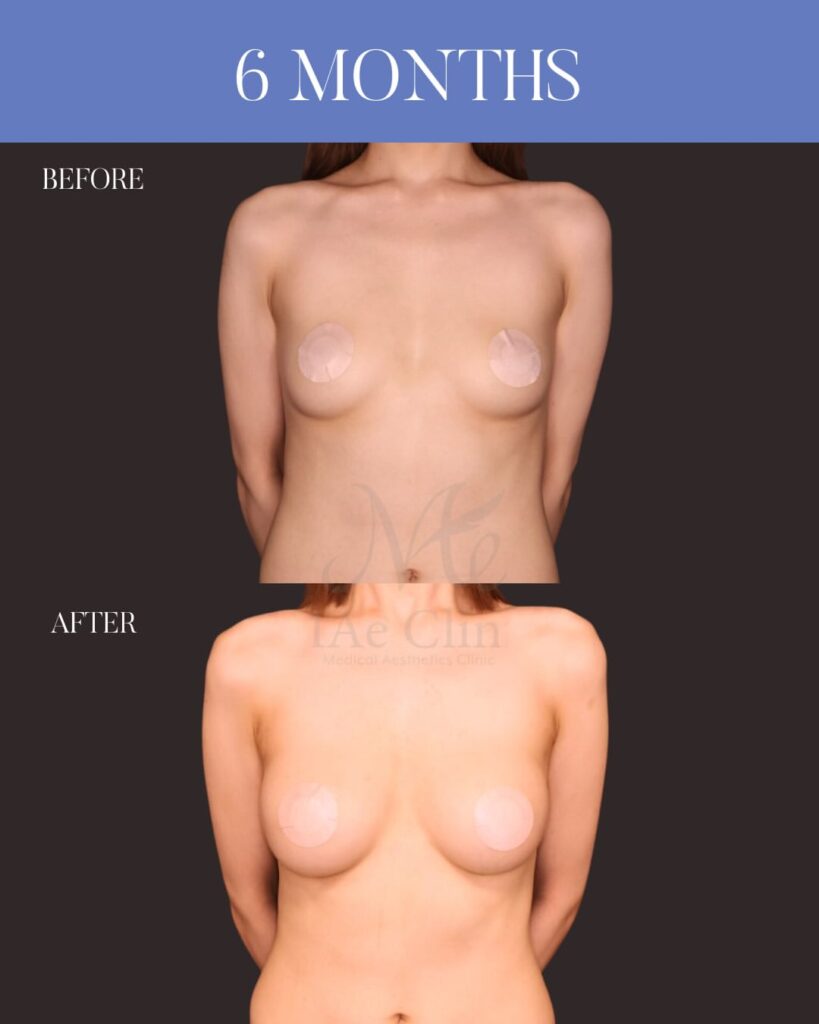 ハイブリッド豊胸 （Motiva Ergonomix2 200cc ＋ コンデンスリッチ脂肪注入 220ml） 木下恵里沙医師症例