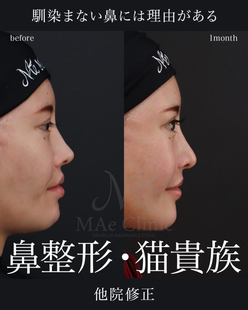 鼻中隔延長（肋軟骨） 鼻尖形成 鼻尖軟骨移植 鼻骨骨切り 隆鼻（肋軟骨） 他院プロテーゼ抜去 猫貴族手術 頬骨アークインフラクチャ 顎先軟骨移植 前田翔医師症例