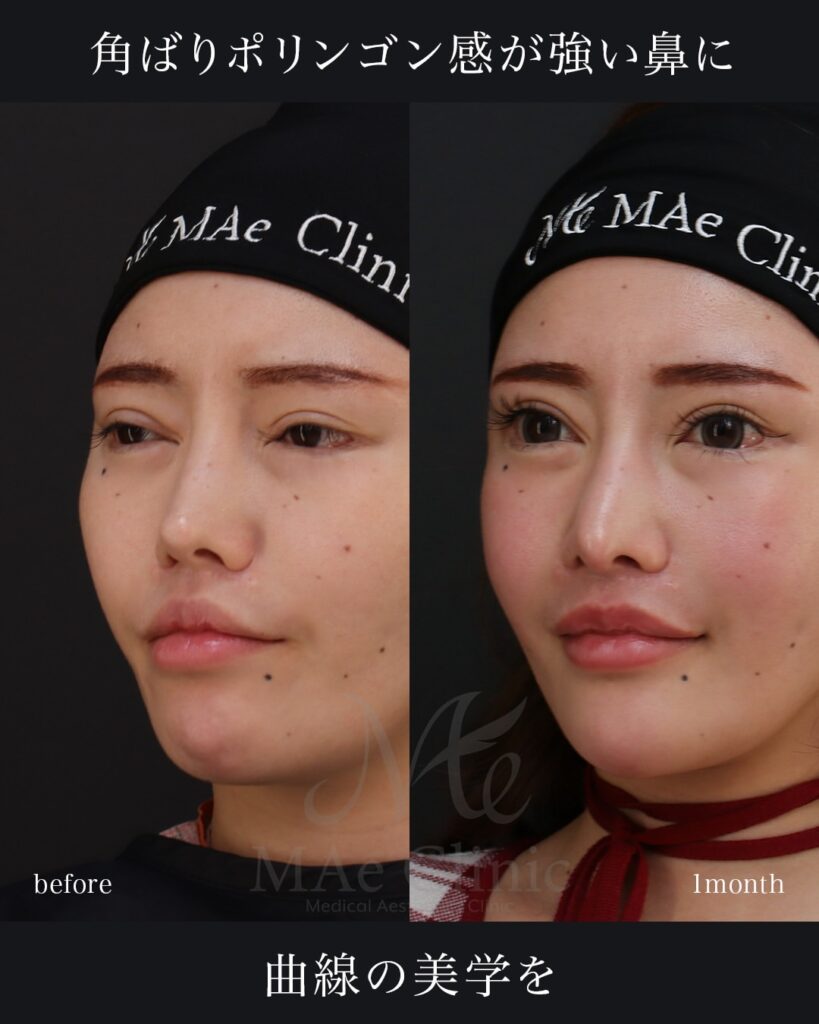 鼻中隔延長（肋軟骨） 鼻尖形成 鼻尖軟骨移植 鼻骨骨切り 隆鼻（肋軟骨） 他院プロテーゼ抜去 猫貴族手術 頬骨アークインフラクチャ 顎先軟骨移植 前田翔医師症例