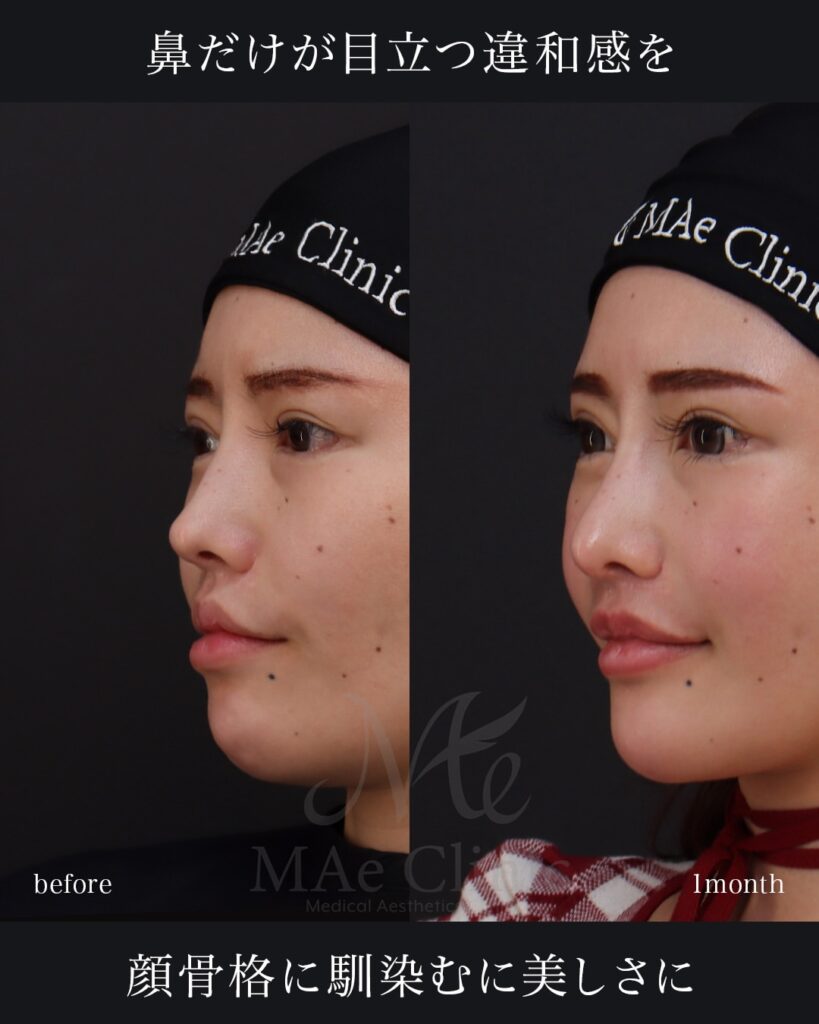 鼻中隔延長（肋軟骨） 鼻尖形成 鼻尖軟骨移植 鼻骨骨切り 隆鼻（肋軟骨） 他院プロテーゼ抜去 猫貴族手術 頬骨アークインフラクチャ 顎先軟骨移植 前田翔医師症例