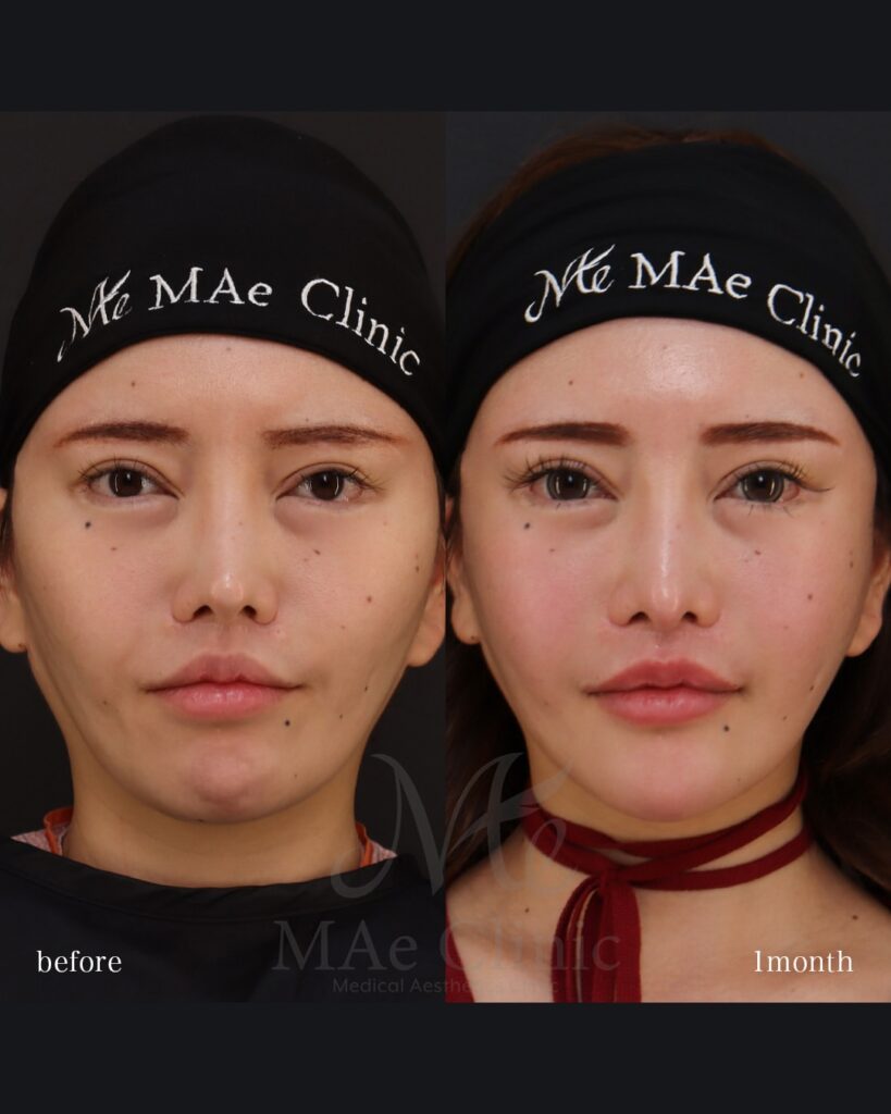 鼻中隔延長（肋軟骨） 鼻尖形成 鼻尖軟骨移植 鼻骨骨切り 隆鼻（肋軟骨） 他院プロテーゼ抜去 猫貴族手術 頬骨アークインフラクチャ 顎先軟骨移植 前田翔医師症例