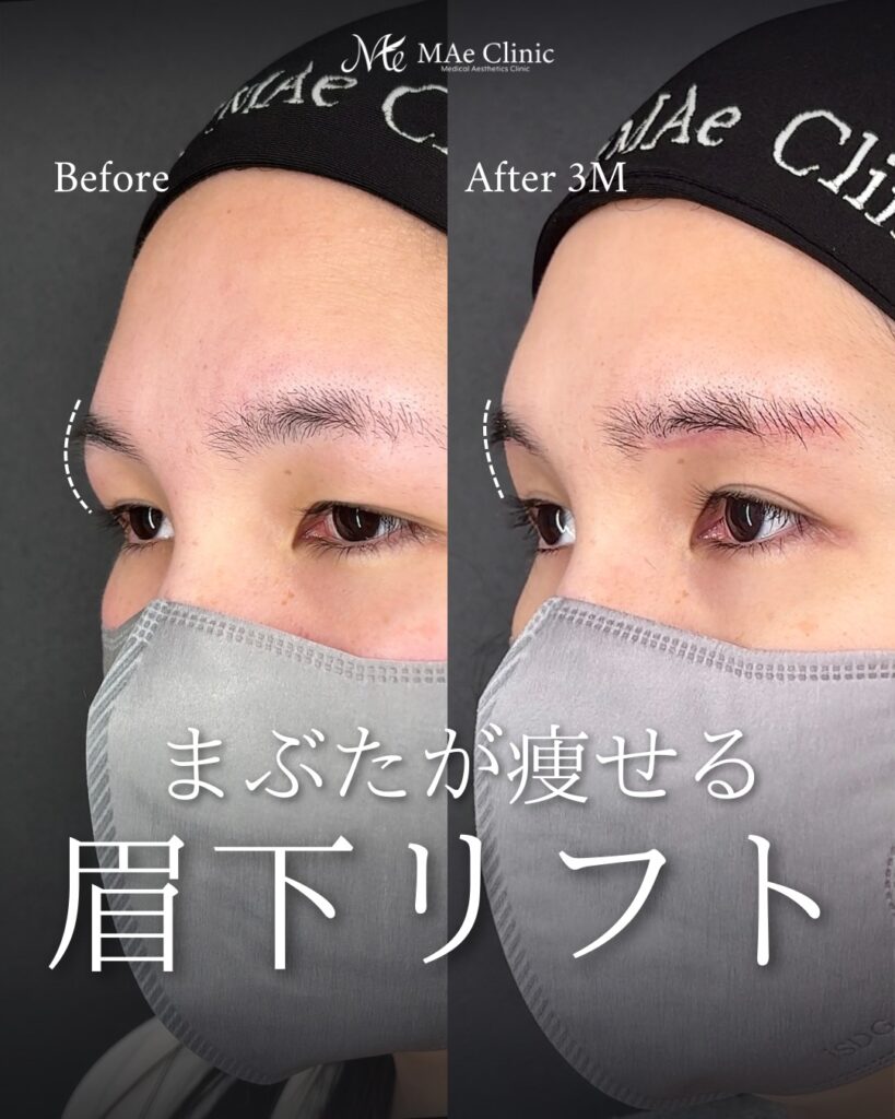 眉下リフト（眉下切開） ROOF切除 眼輪筋切除
術後3ヵ月症例
前之園健太医師
