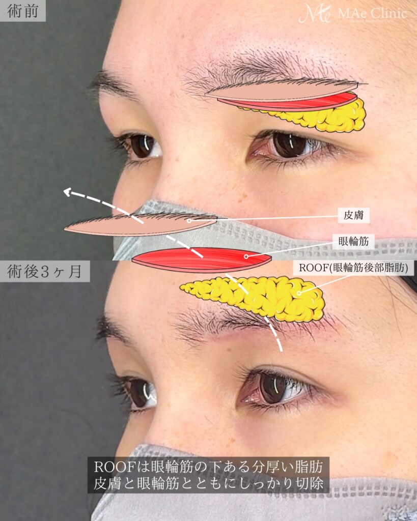 眉下リフト（眉下切開） ROOF切除 眼輪筋切除 術後3ヵ月症例 前之園健太医師
