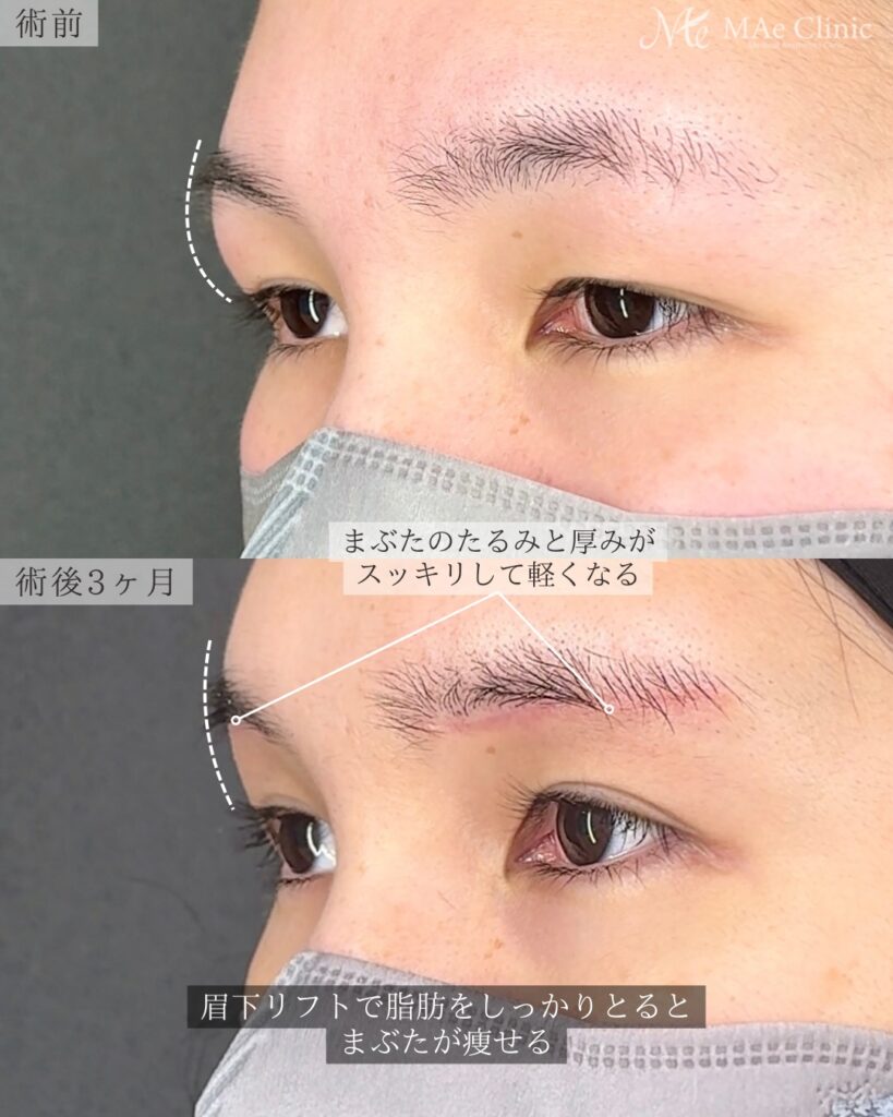 眉下リフト（眉下切開） ROOF切除 眼輪筋切除 術後3ヵ月症例 前之園健太医師